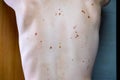 Melanocytic nevus, some of them dyplastic or atypical, on a caucasian man of 36 years old