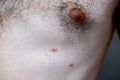 Melanocytic nevus, some of them dyplastic or atypical, on a caucasian man of 36 years old Royalty Free Stock Photo
