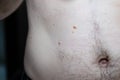Melanocytic nevus, some of them dyplastic or atypical, on a caucasian man of 36 years old