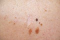 Melanocytic nevus, some of them dyplastic or atypical, on a caucasian man of 37 years old from Spain