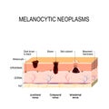 Melanocytic nevus. difference between a birthmark, mole and nevus Royalty Free Stock Photo