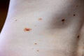 Melanocytic nevus, some of them dyplastic or atypical, on a caucasian man of 36 years old Royalty Free Stock Photo