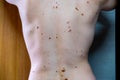 Melanocytic nevus, some of them dyplastic or atypical, on a caucasian man of 36 years old Royalty Free Stock Photo