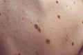 Melanocytic nevus, some of them dyplastic or atypical, on a caucasian man of 37 years old from Spain Royalty Free Stock Photo