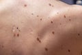 Melanocytic nevus, some of them dyplastic or atypical, on a caucasian man of 37 years old from Spain Royalty Free Stock Photo
