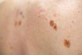 Melanocytic nevus, some of them dyplastic or atypical, on a caucasian man of 37 years old from Spain Royalty Free Stock Photo