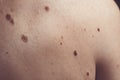 Melanocytic nevus, some of them dyplastic or atypical, on a caucasian man of 37 years old from Spain Royalty Free Stock Photo