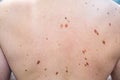 Melanocytic nevus, some of them dyplastic or atypical, on a caucasian man of 37 years old from Spain Royalty Free Stock Photo