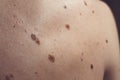 Melanocytic nevus, some of them dyplastic or atypical, on a caucasian man of 37 years old from Spain Royalty Free Stock Photo