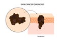 Skin cancer diagnosis Royalty Free Stock Photo