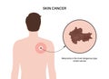 Skin cancer diagnosis