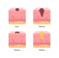 Melanoma cancer anatomical infographic poster. Vector flat medical illustration. Comparison of nevus, tumor, birthmark and