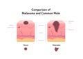 Melanoma cancer anatomical infographic poster. Vector flat medical illustration. Comparison of tumor and common mole with text.