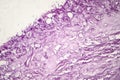 Melanoma, a cancer developing from pigment-containing cells melanocytes Royalty Free Stock Photo