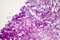 Melanoma, a cancer developing from pigment-containing cells melanocytes Royalty Free Stock Photo