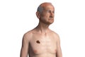 Melanoma on chest skin, a cancer developing from pigment-containing cells melanocytes