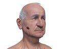 Melanoma on face skin, computer illustration