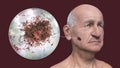 Melanoma on face skin, computer illustration
