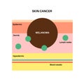 Melanoma graphic poster