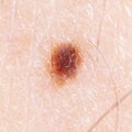 Melanoma on the human skin as a background