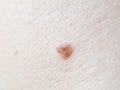 Melanoma on human skin, close up
