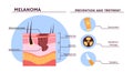 Melanoma infografics vector concept