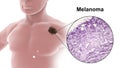 Melanoma on a male body