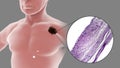 Melanoma on a male body Royalty Free Stock Photo