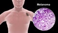 Melanoma on a male body