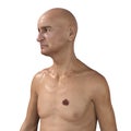 Melanoma on man's chest skin, a cancer developing from pigment-containing cells melanocytes