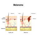 Melanoma or skin cancer.