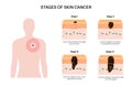 Melanoma stages poster