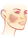 Melasma illustration Royalty Free Stock Photo