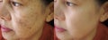 Melasma pigmentation facial treatment.