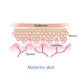 Melasma skin layer .