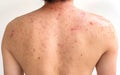 Men with acne, with red spots on the back Royalty Free Stock Photo