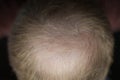 Men hair loss problem alopecia