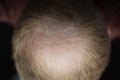 Men hair loss problem alopecia