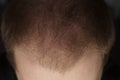 Men hair loss problem alopecia