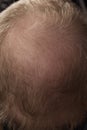 Men hair loss problem alopecia