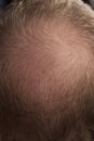 Men hair loss problem alopecia