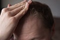 Men hair loss problem alopecia