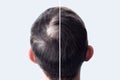 Men hair after using cosmetic powder hair thickening. Crown with bald head. Before and after