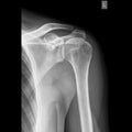 Shoulder joint x-ray image AP view