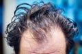 Men`s dirty unkempt hair early in the morning