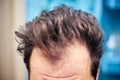 Men`s dirty unkempt hair early in the morning