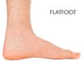 Men's foot. Flatfoot second degree. Royalty Free Stock Photo