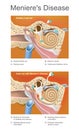 Meniere disease. Illustration. Disorder of the inner ear that ca