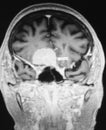 Meningioma mri image radiological examination