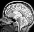 Meningioma mri image radiological examination